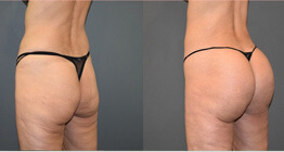 Brazillian Butt Lift surgery