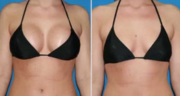 breast Reduction